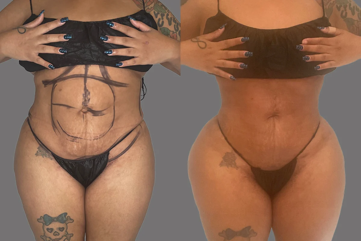 Before and after — J-Plasma Skin Tightening · Brooklyn, patient 1