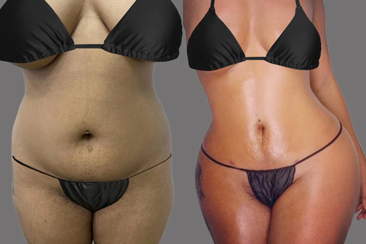 Before and after — J-Plasma para Tensar la Piel, patient 1