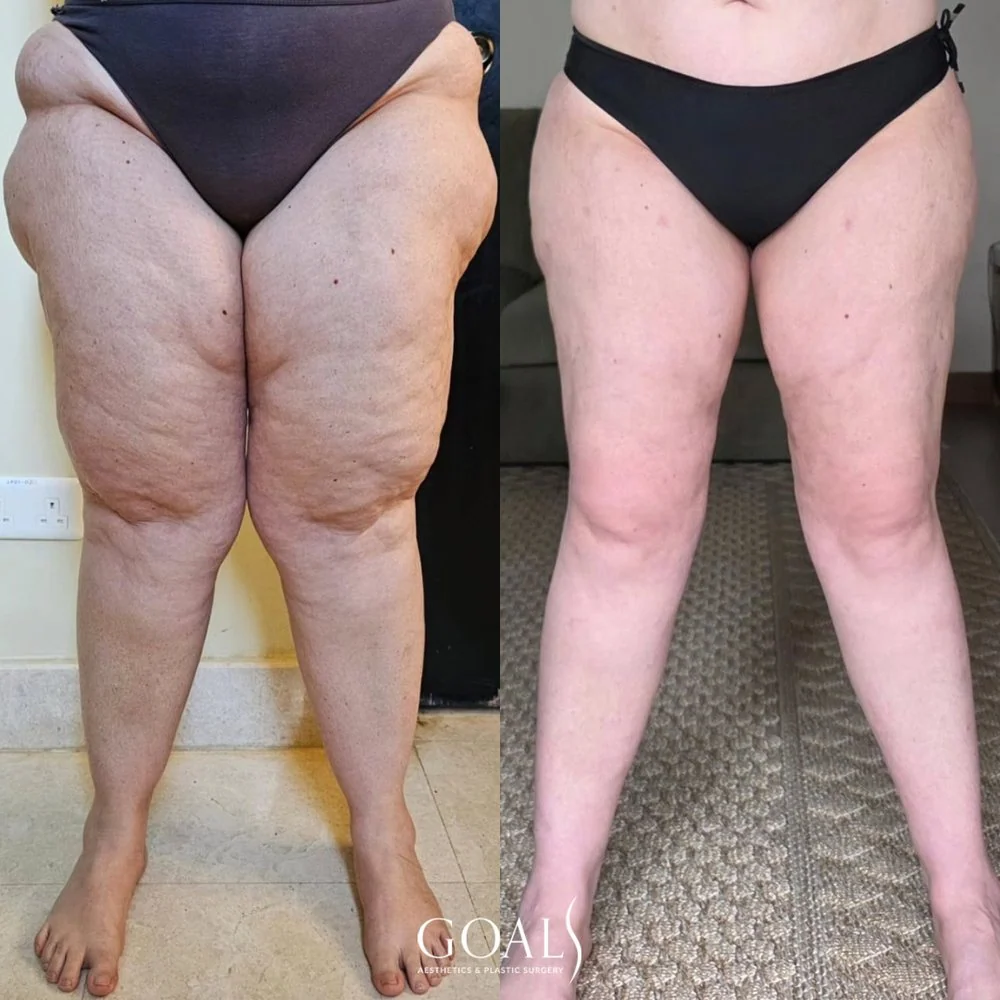 Before and after — Lipedema Treatment, patient 2