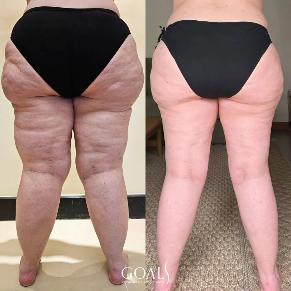 Before and after — Lipedema Treatment, patient 3