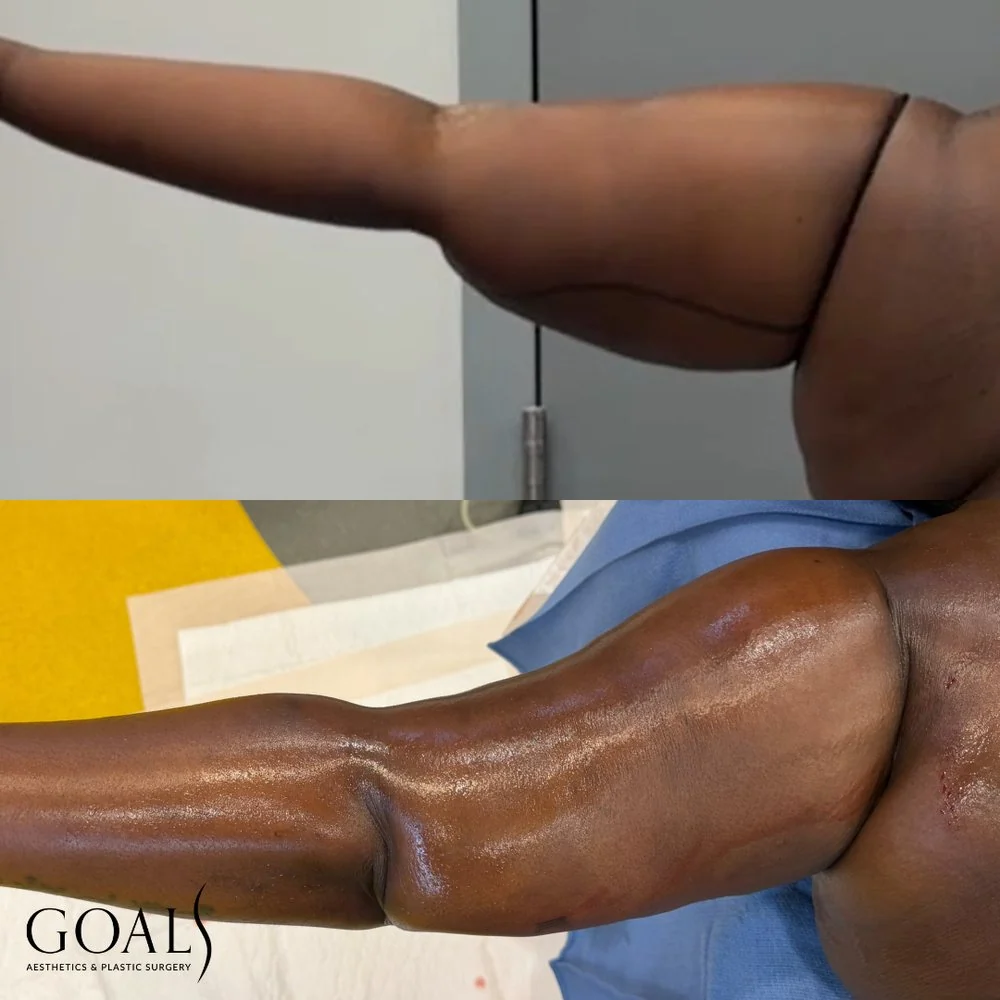Before and after — Lipedema Treatment, patient 1