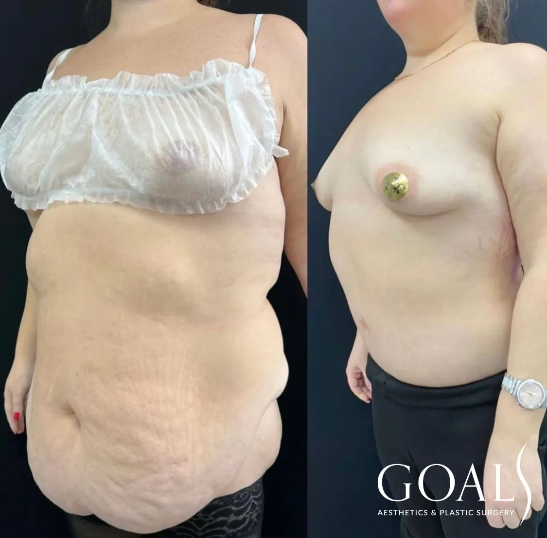 Before and after — Mommy Makeover, patient 2