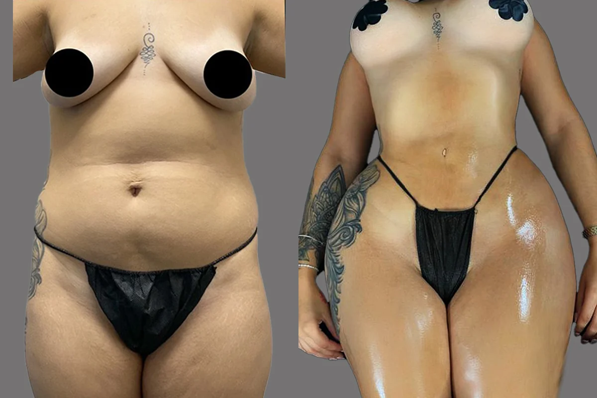 Before and after — Mommy Makeover, patient 3