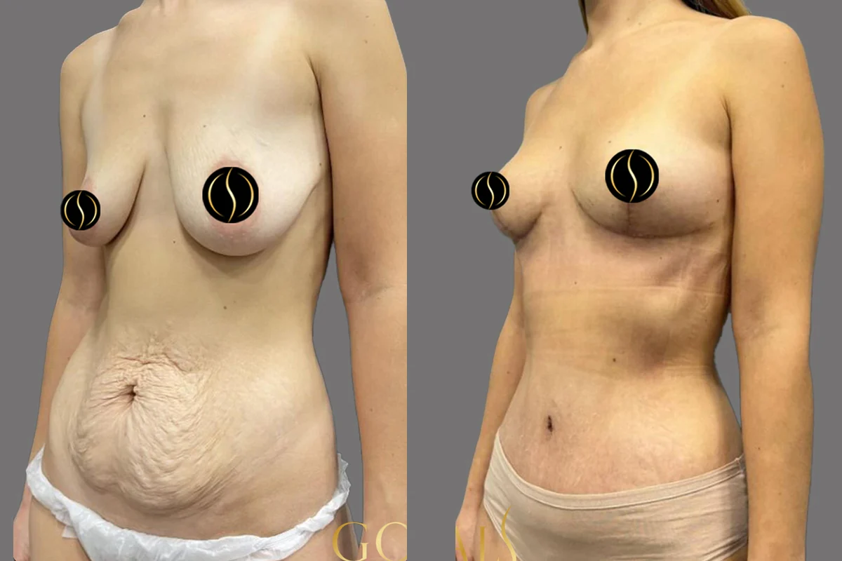 Before and after — Mommy Makeover, patient 4