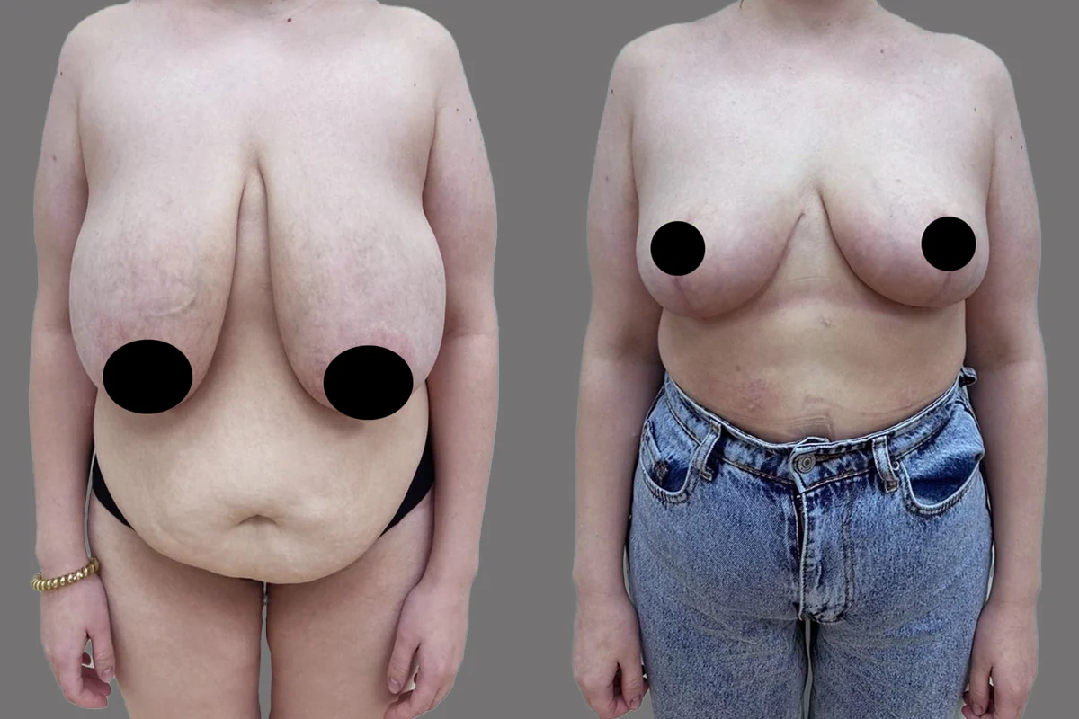 Before and after — Mommy Makeover, patient 5