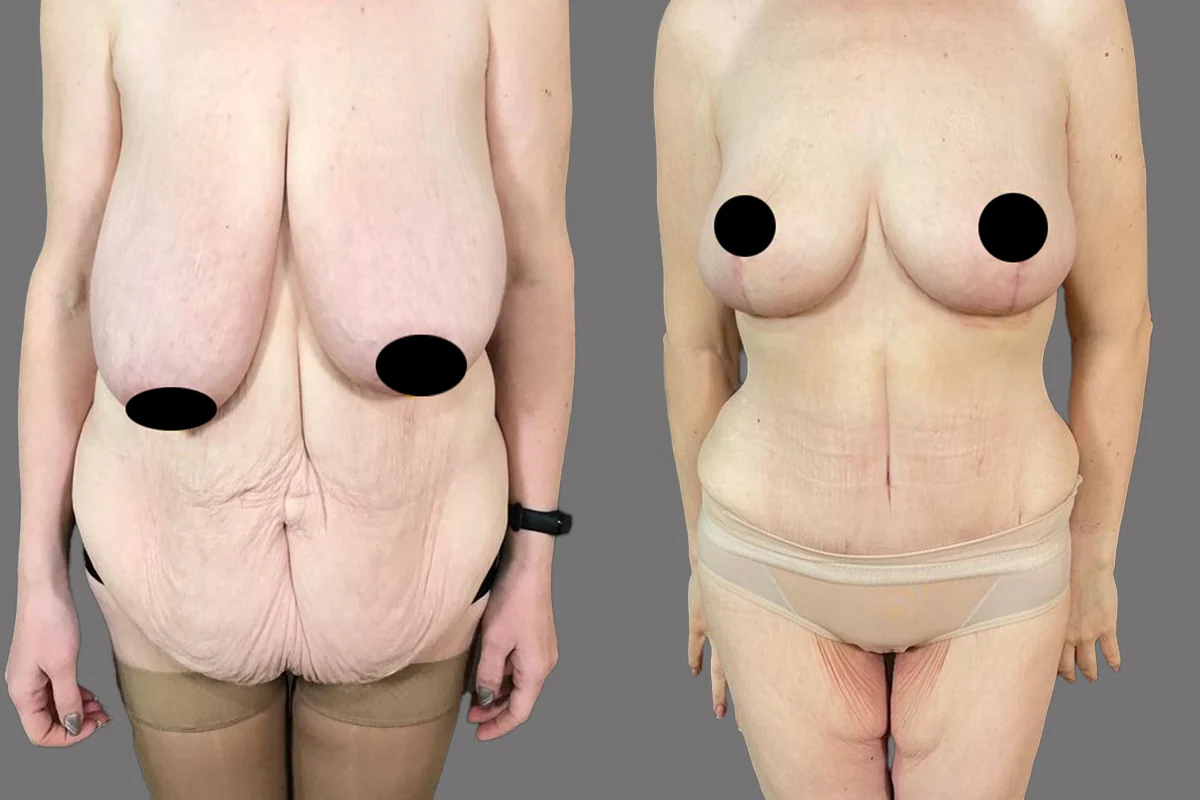Before and after — Mommy Makeover, patient 6