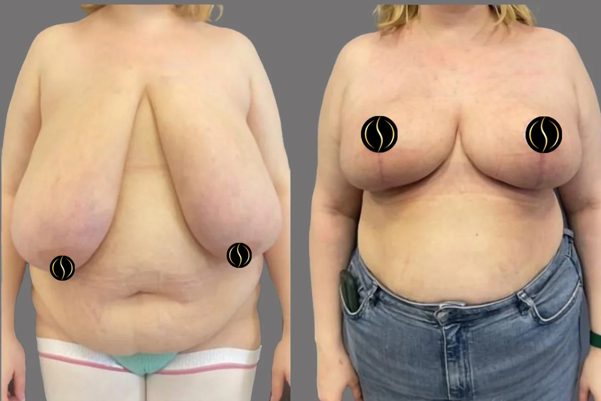 Before and after — Mommy Makeover, patient 2