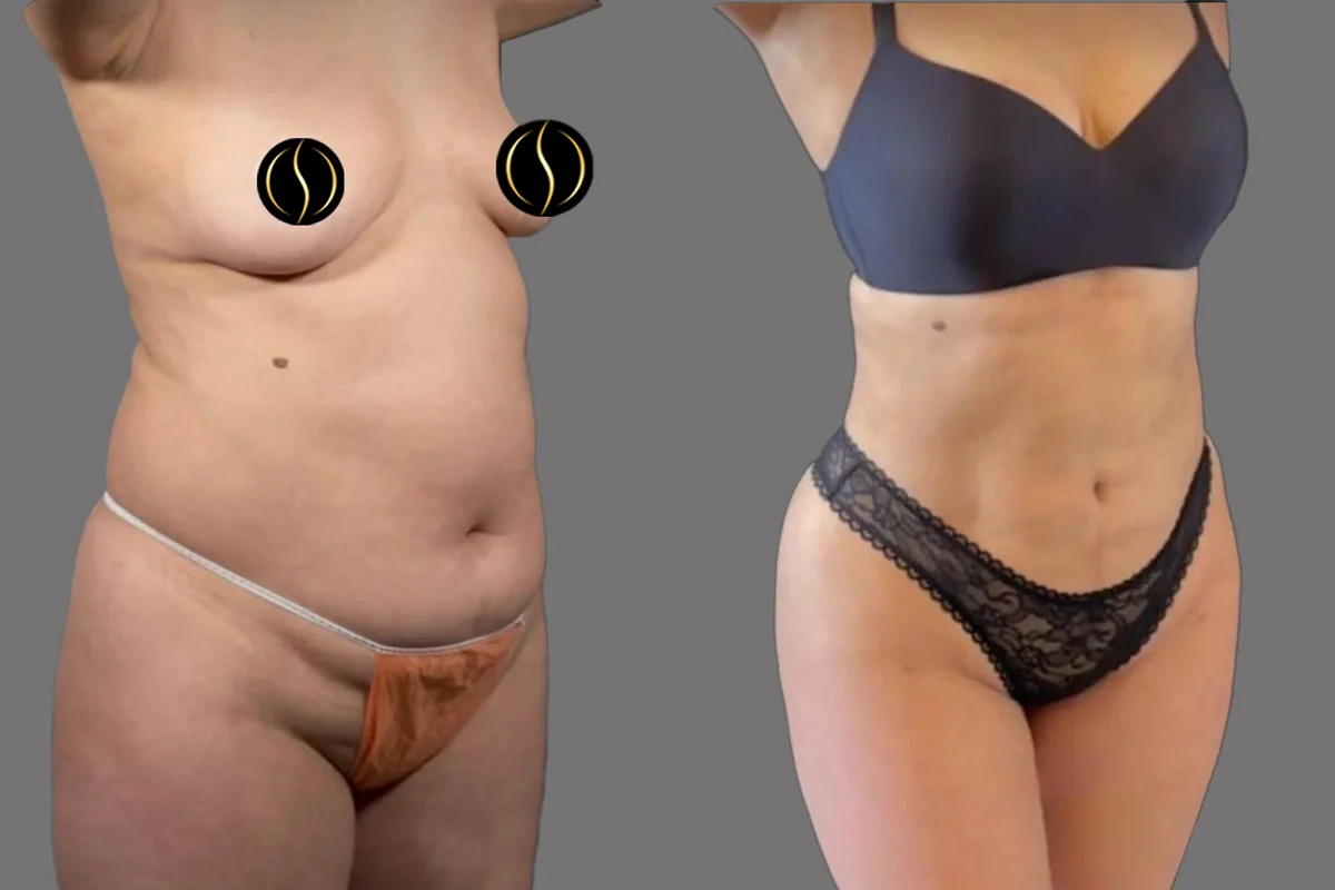 Before and after — Mommy Makeover, patient 3