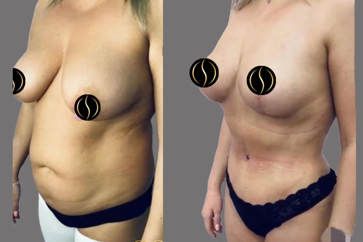 Before and after — Mommy Makeover · Brooklyn, patient 1