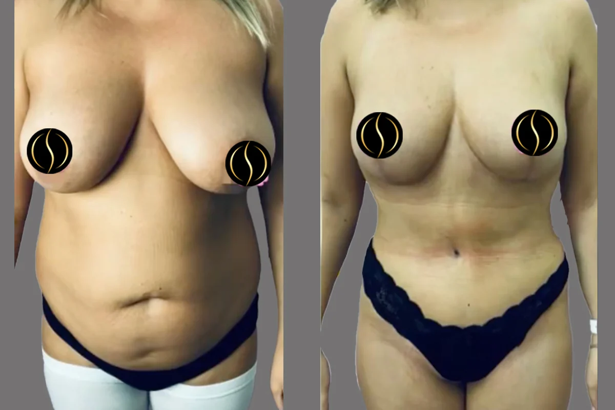 Before and after — Mommy Makeover, patient 1