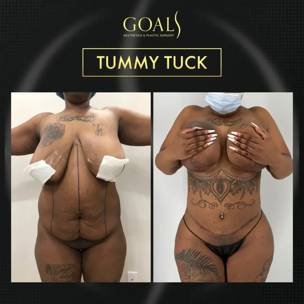 Antes y después de Abdominoplastia, IMC inicial 30-35