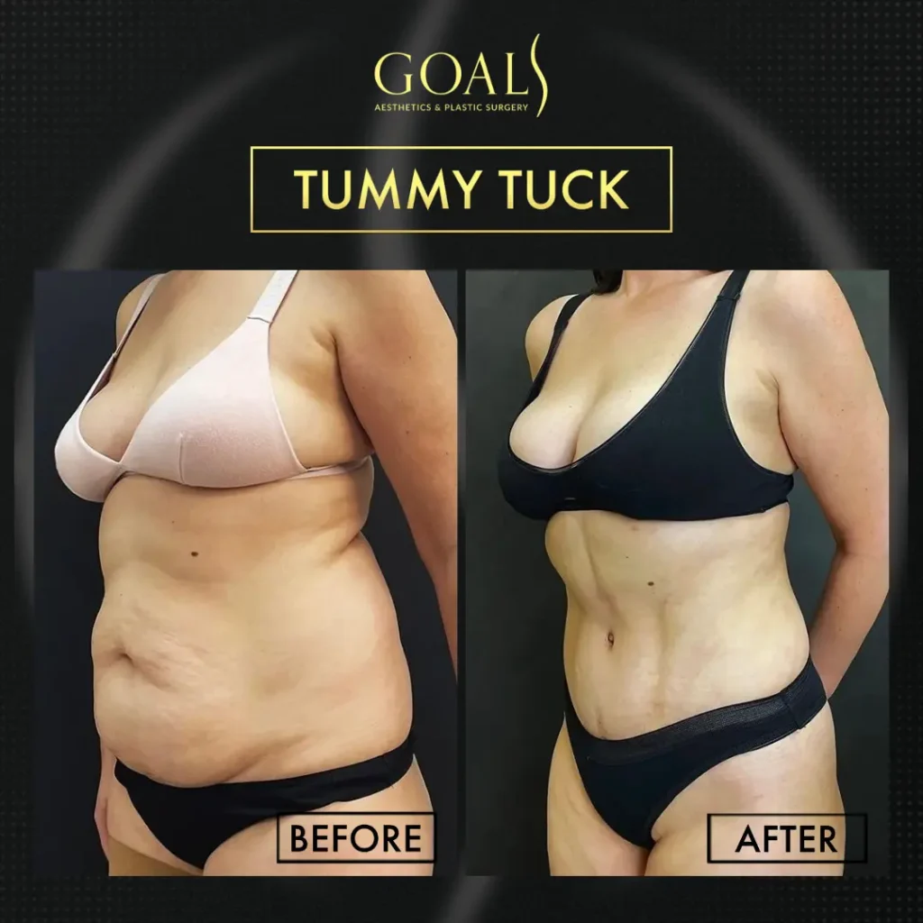 Tummy Tuck — patient result