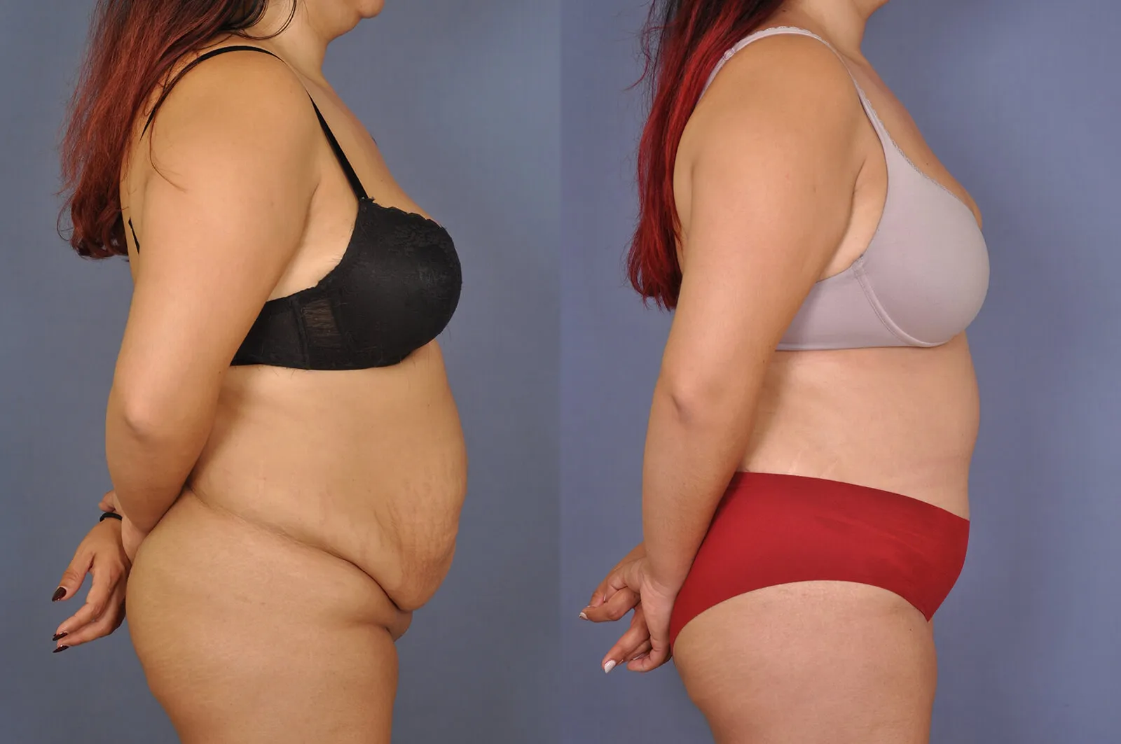 Before and after — Fair Lawn, patient 1