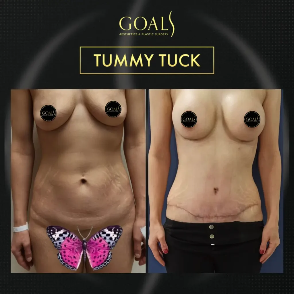 Tummy Tuck — patient result