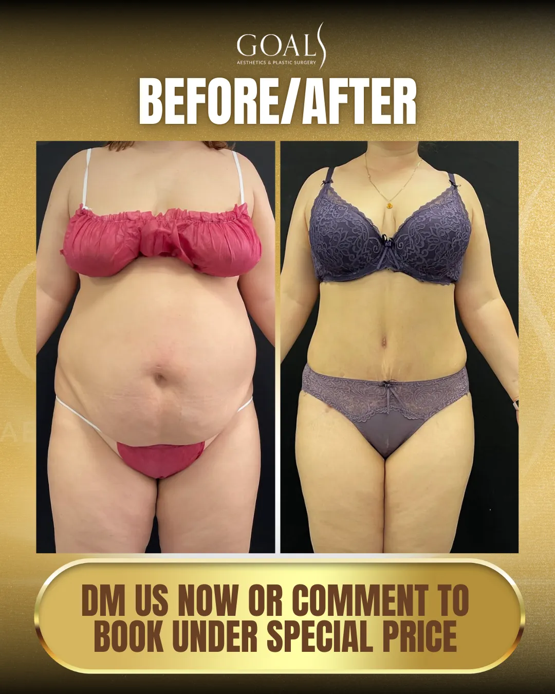 Before and after — Tummy Tuck · Harlem, patient 1
