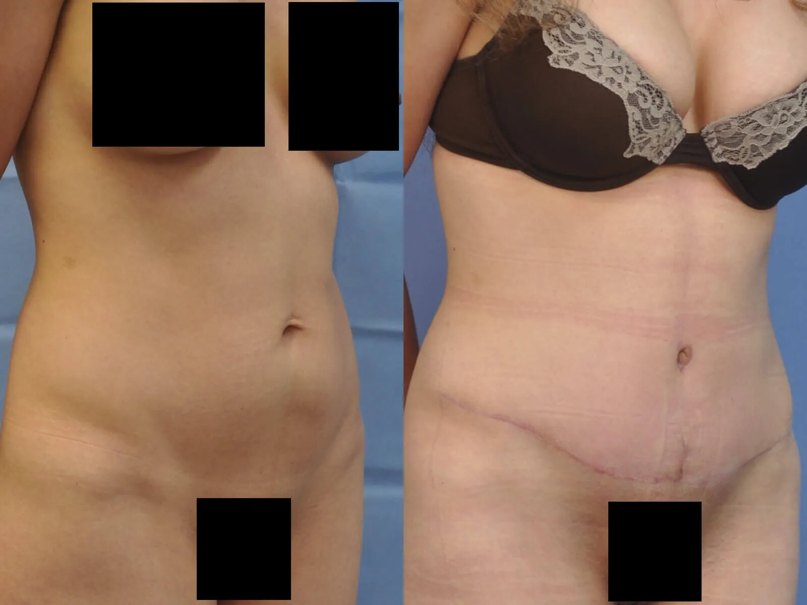 Before and after — Tummy Tuck · Harlem, patient 2