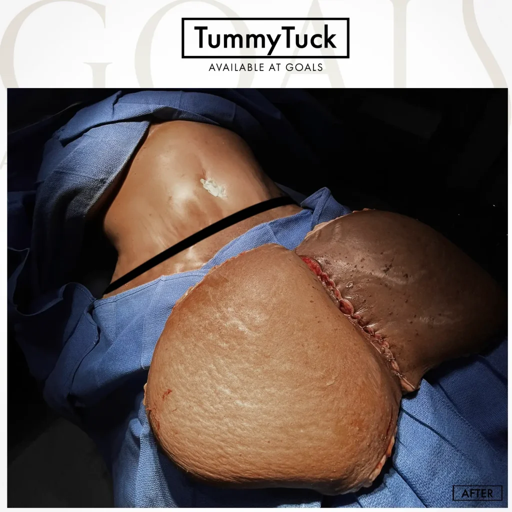 Before and after — Tummy Tuck · Harlem, patient 3