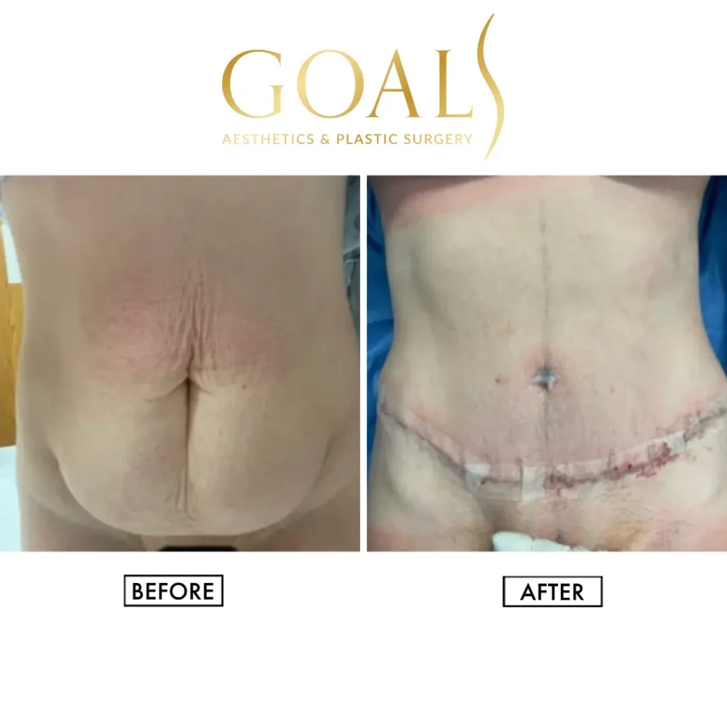 Before and after — Tummy Tuck · Harlem, patient 5
