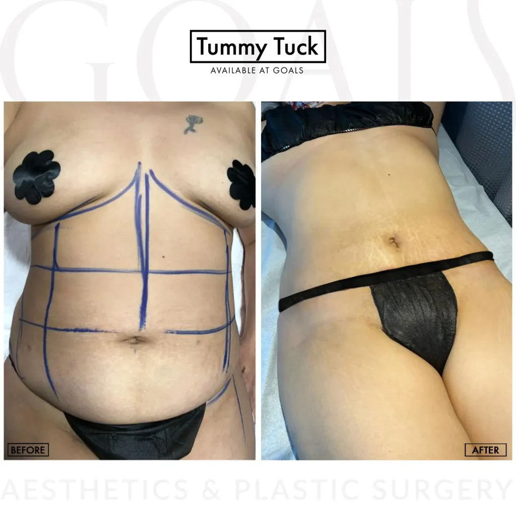 Before and after — Tummy Tuck · Harlem, patient 6