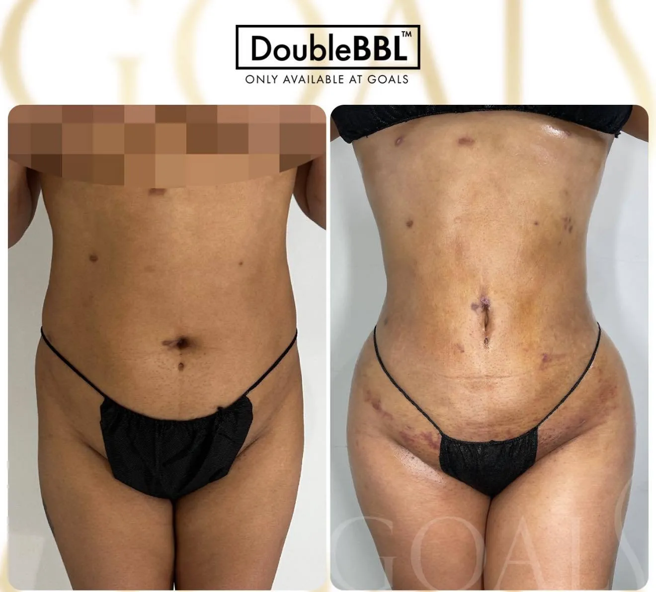 Before and after — Abdominoplastia · Ridgefield, patient 2