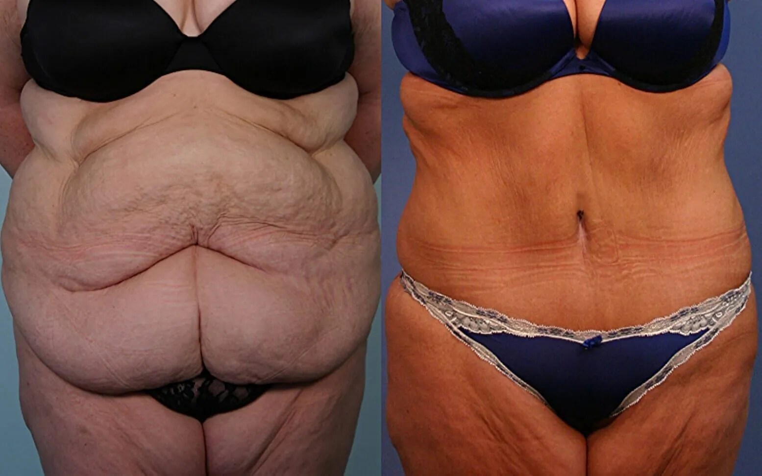 Before and after — Abdominoplastia · Ridgefield, patient 3