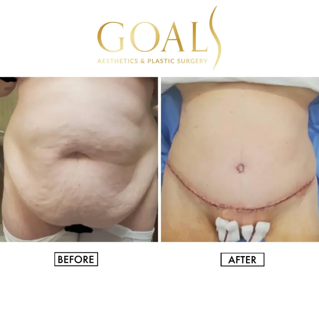 Before and after — Tummy Tuck · Gaithersburg, patient 1
