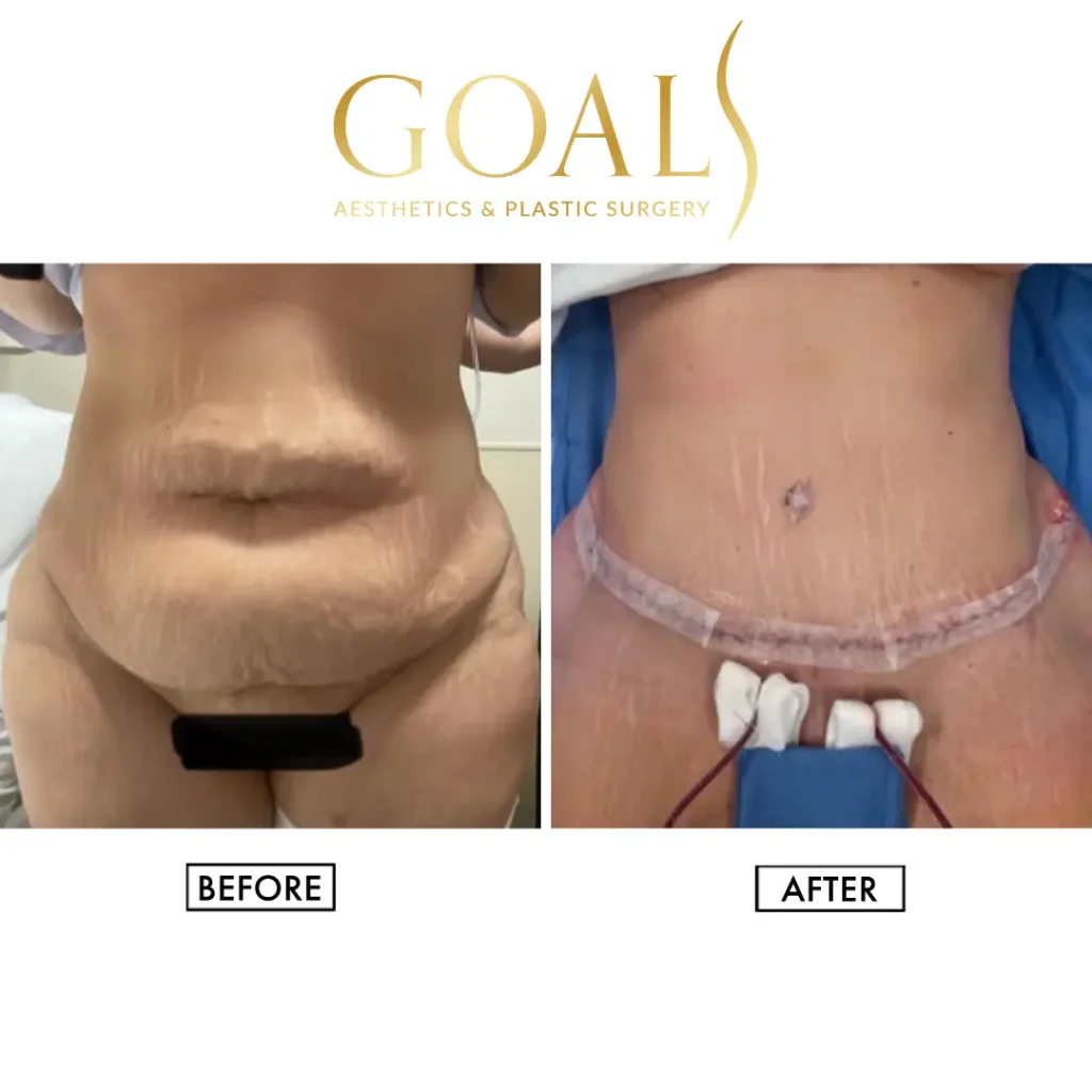 Before and after — Tummy Tuck · Gaithersburg, patient 3