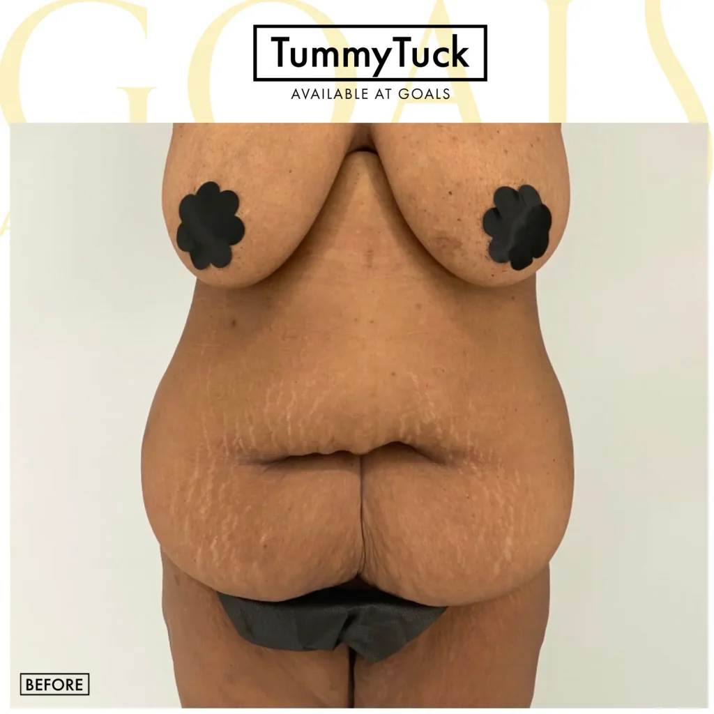 Before and after — Tummy Tuck · Gaithersburg, patient 4