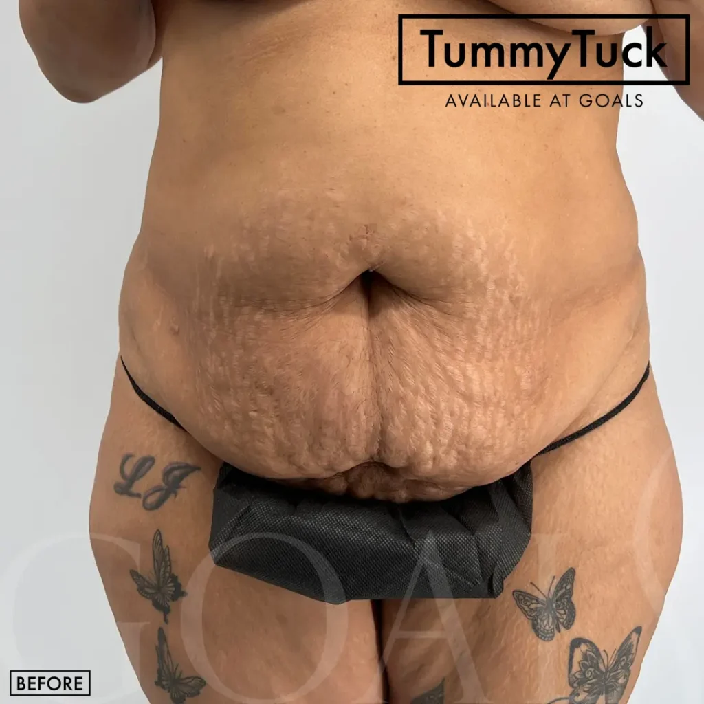 Before and after — Tummy Tuck · Gaithersburg, patient 6