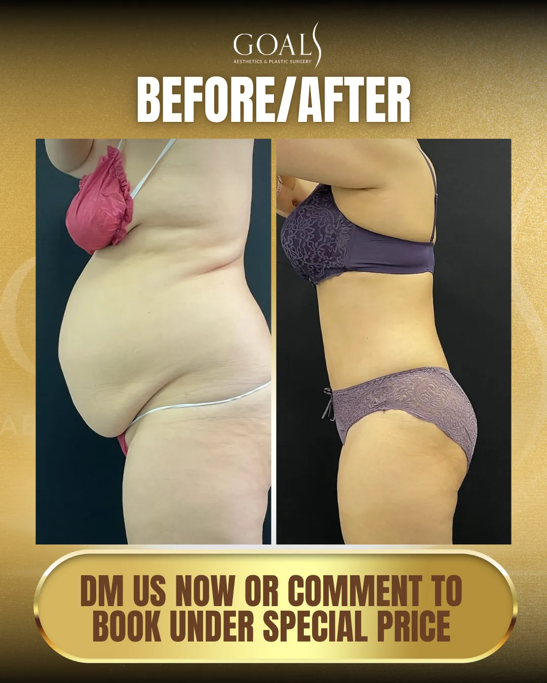 Before and after — Tummy Tuck · Houston, patient 1