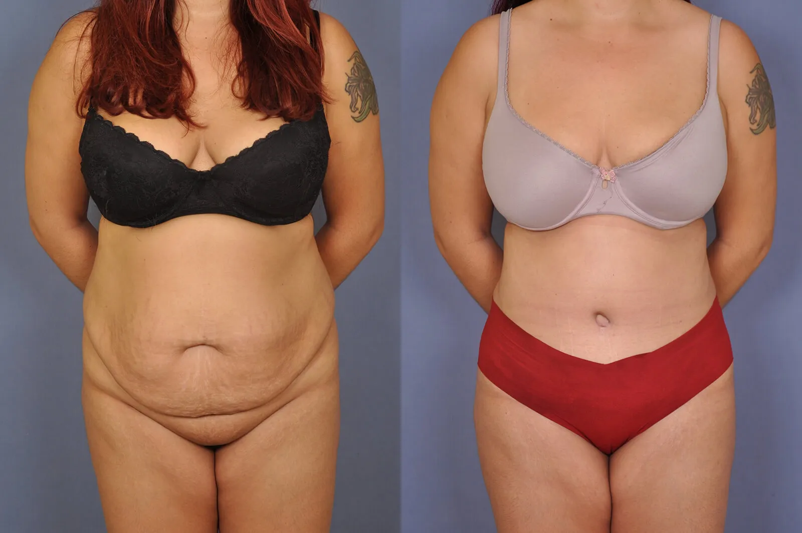 Before and after — Tummy Tuck · Houston, patient 3