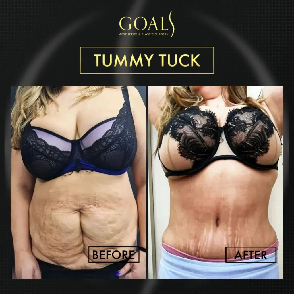 Before and after — Tummy Tuck · Houston, patient 4