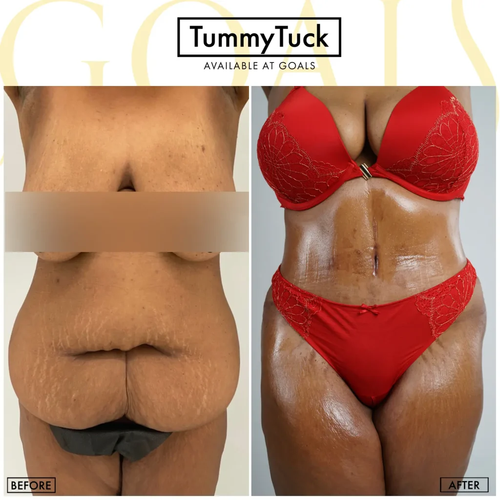 Before and after — Tummy Tuck · Houston, patient 5