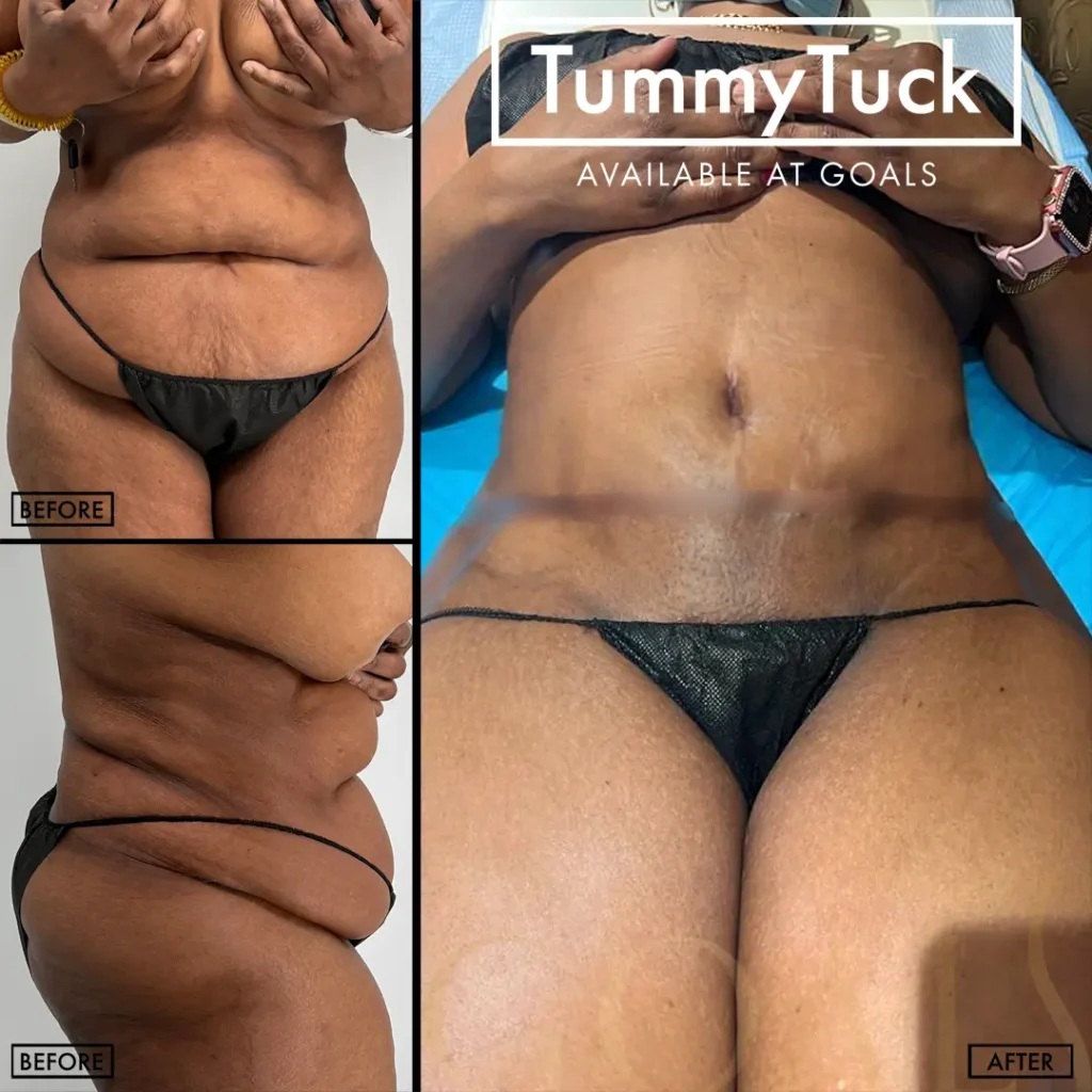 Before and after — Tummy Tuck · Houston, patient 6