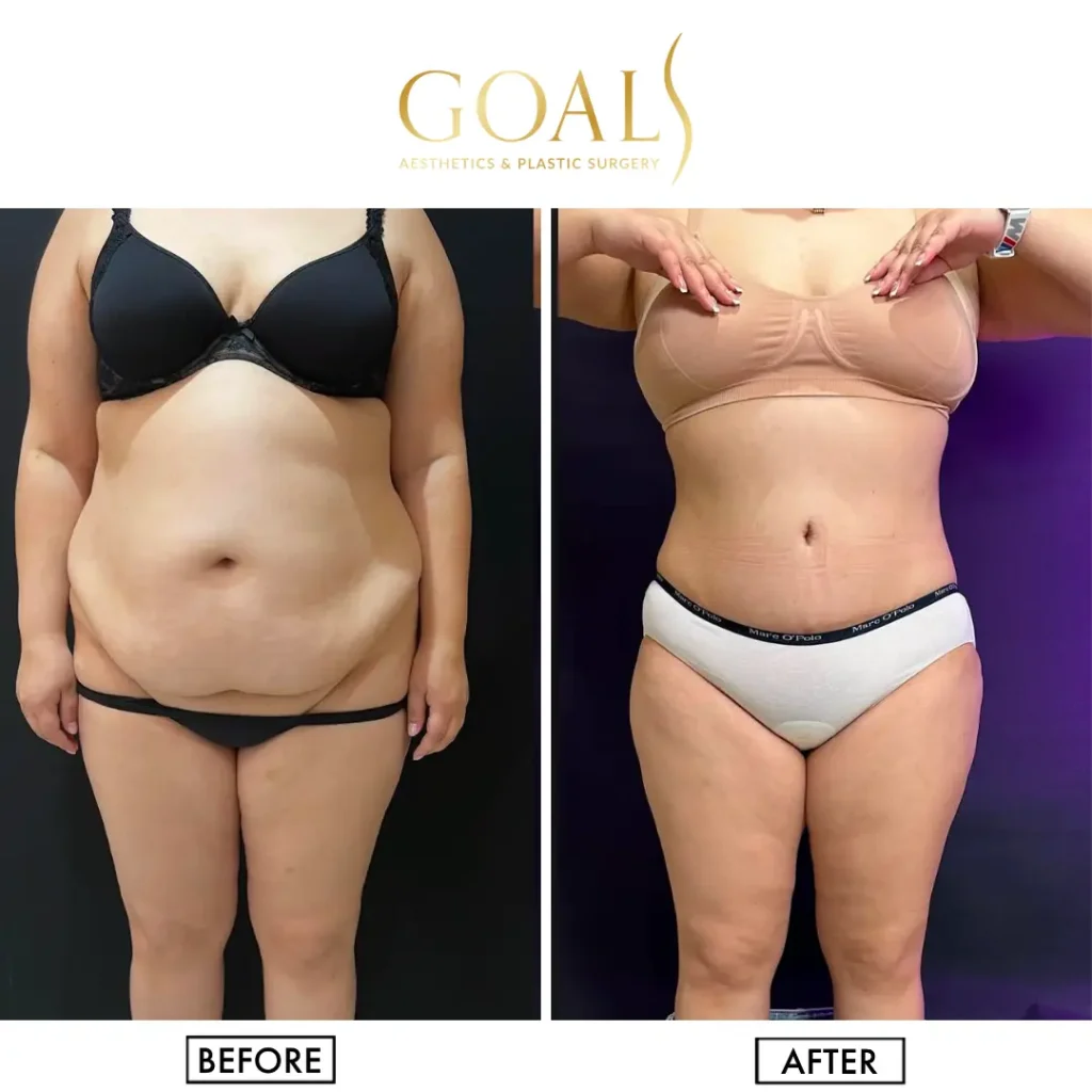 Before and after — Tummy Tuck, patient 2