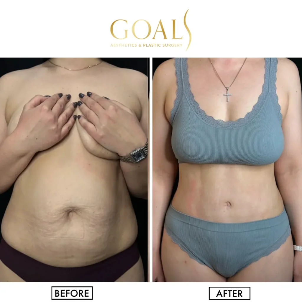 Before and after — Tummy Tuck, patient 3