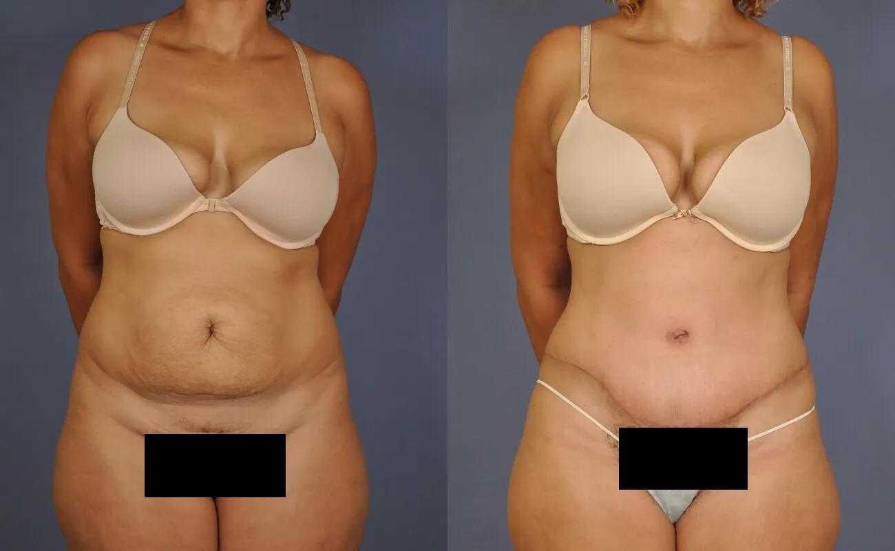 Before and after — Tummy Tuck, patient 4