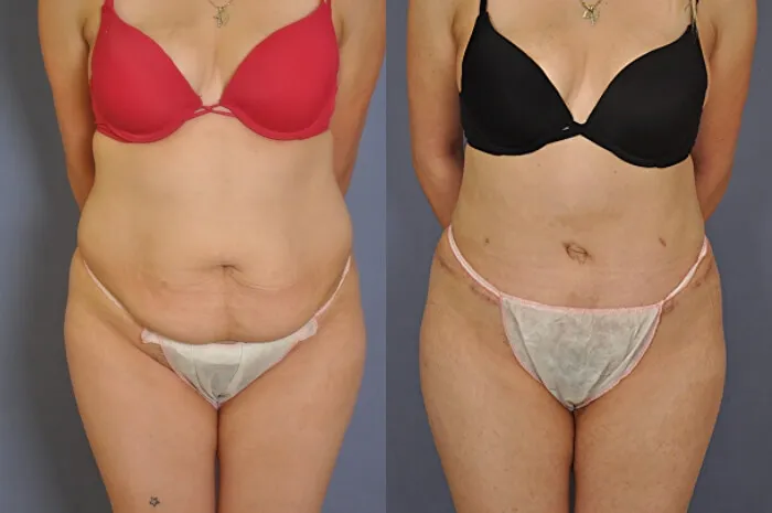 Before and after — Tummy Tuck, patient 5