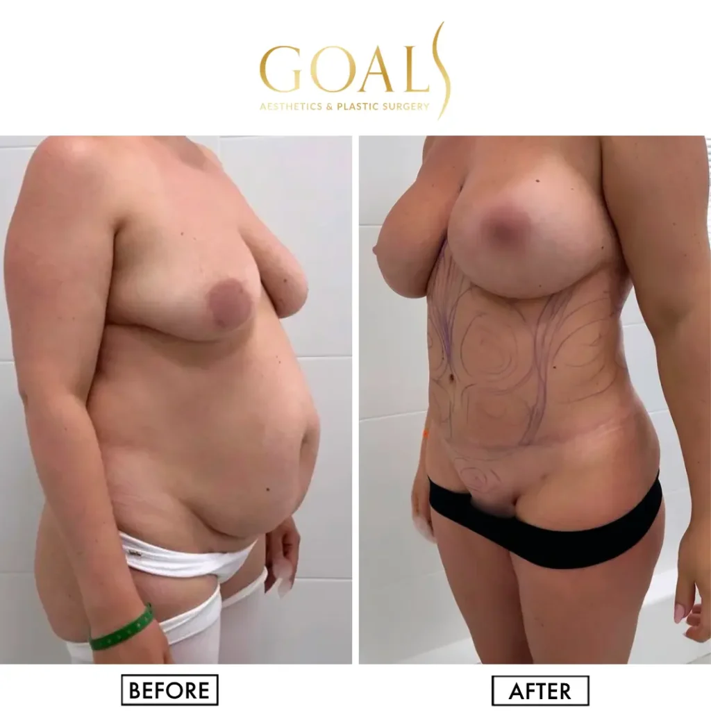 Before and after — Tummy Tuck, patient 6