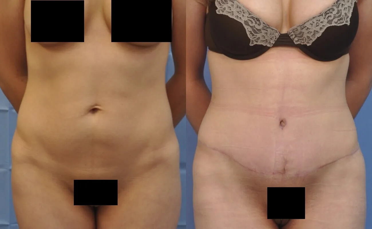 Before and after, patient 6