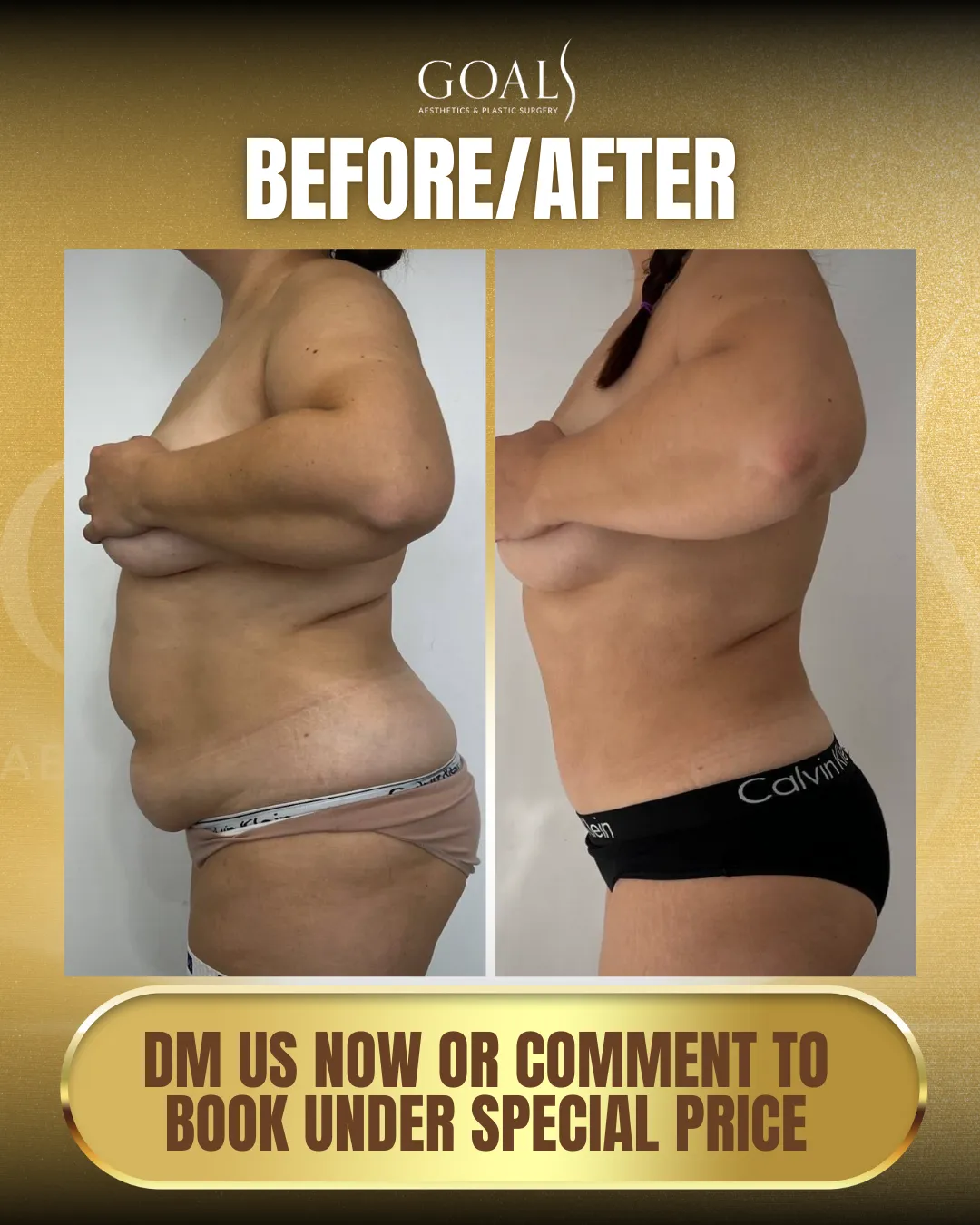 Before and after — Abdominoplastia · Atlanta Tucker Rd., patient 1