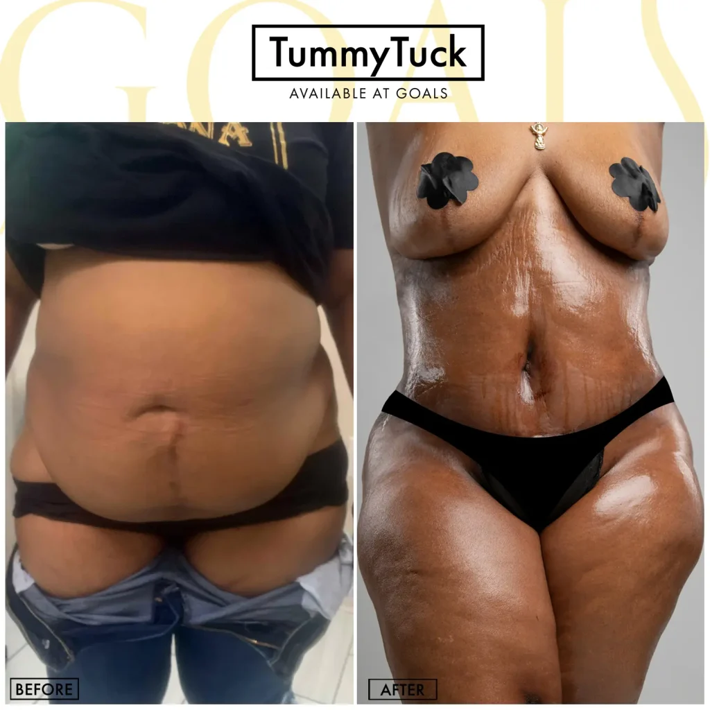 Before and after — Abdominoplastia · Atlanta Tucker Rd., patient 2