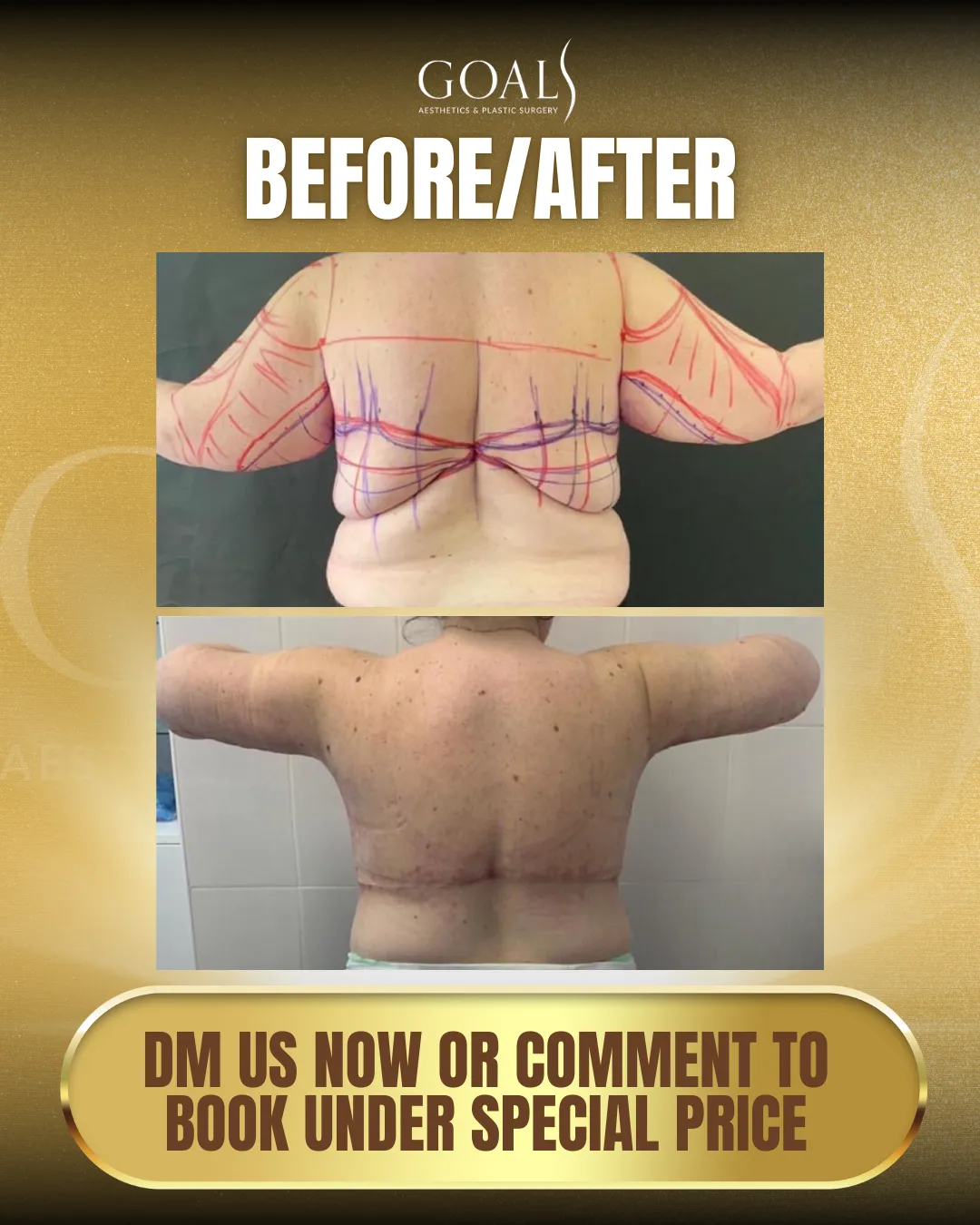 Before and after — Abdominoplastia · Atlanta Tucker Rd., patient 3