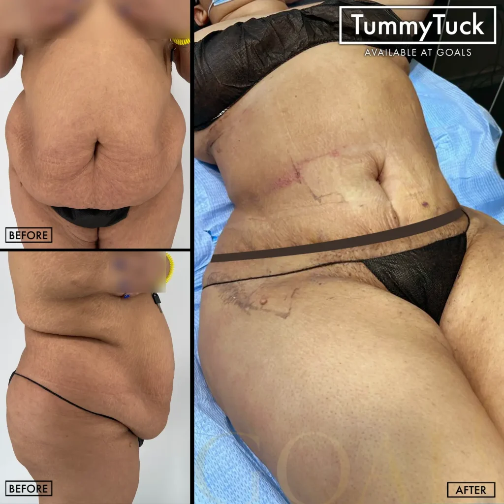 Before and after — Abdominoplastia · Atlanta Tucker Rd., patient 4