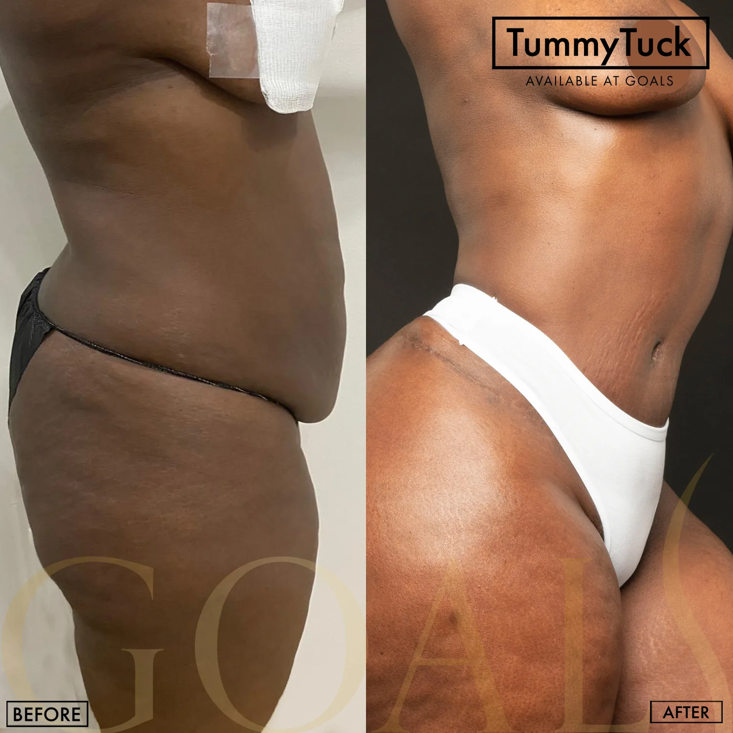 Before and after — Abdominoplastia · Atlanta Tucker Rd., patient 5