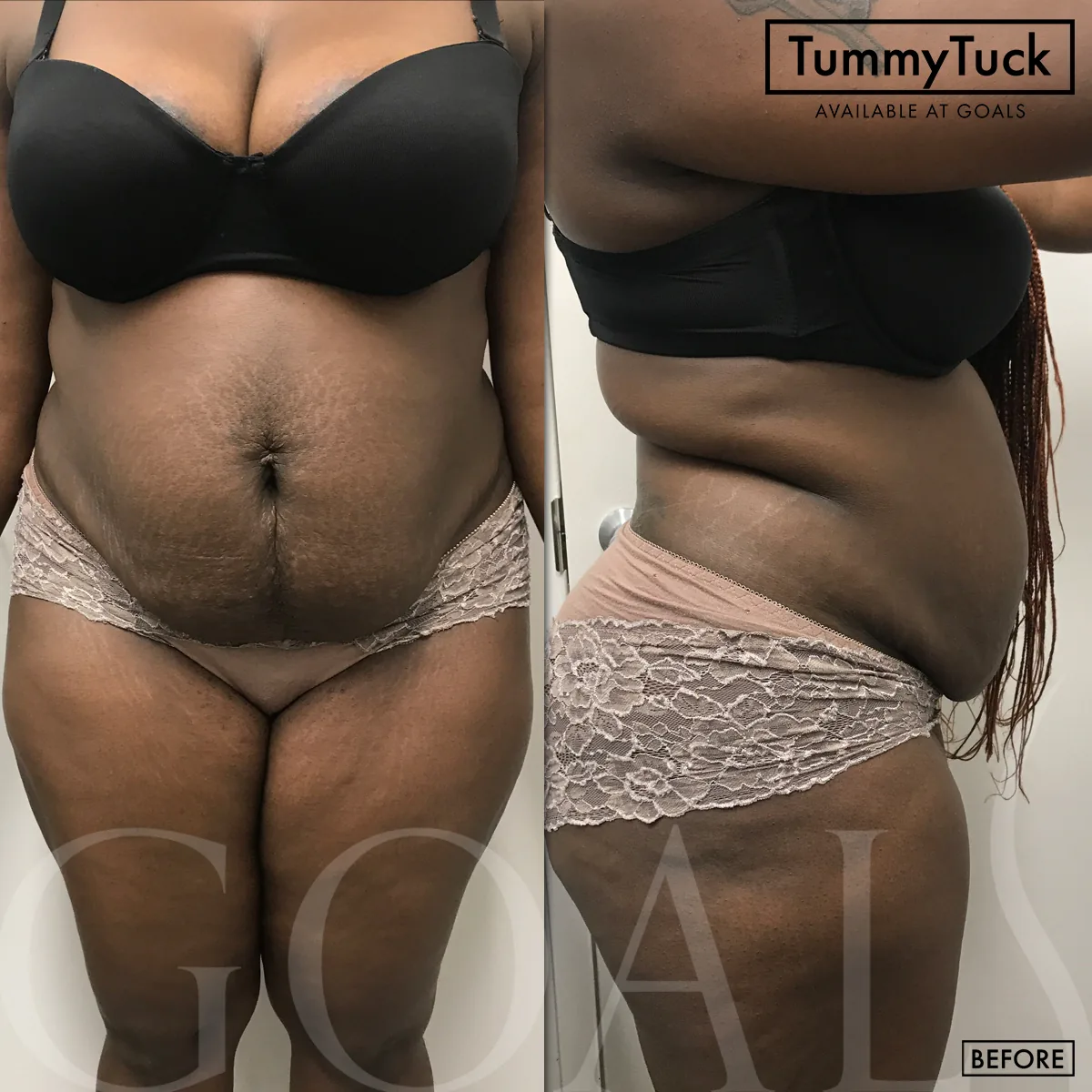Before and after — Tummy Tuck, patient 1