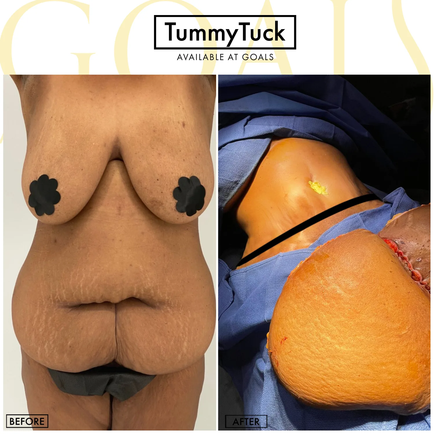 Before and after — Tummy Tuck, patient 2
