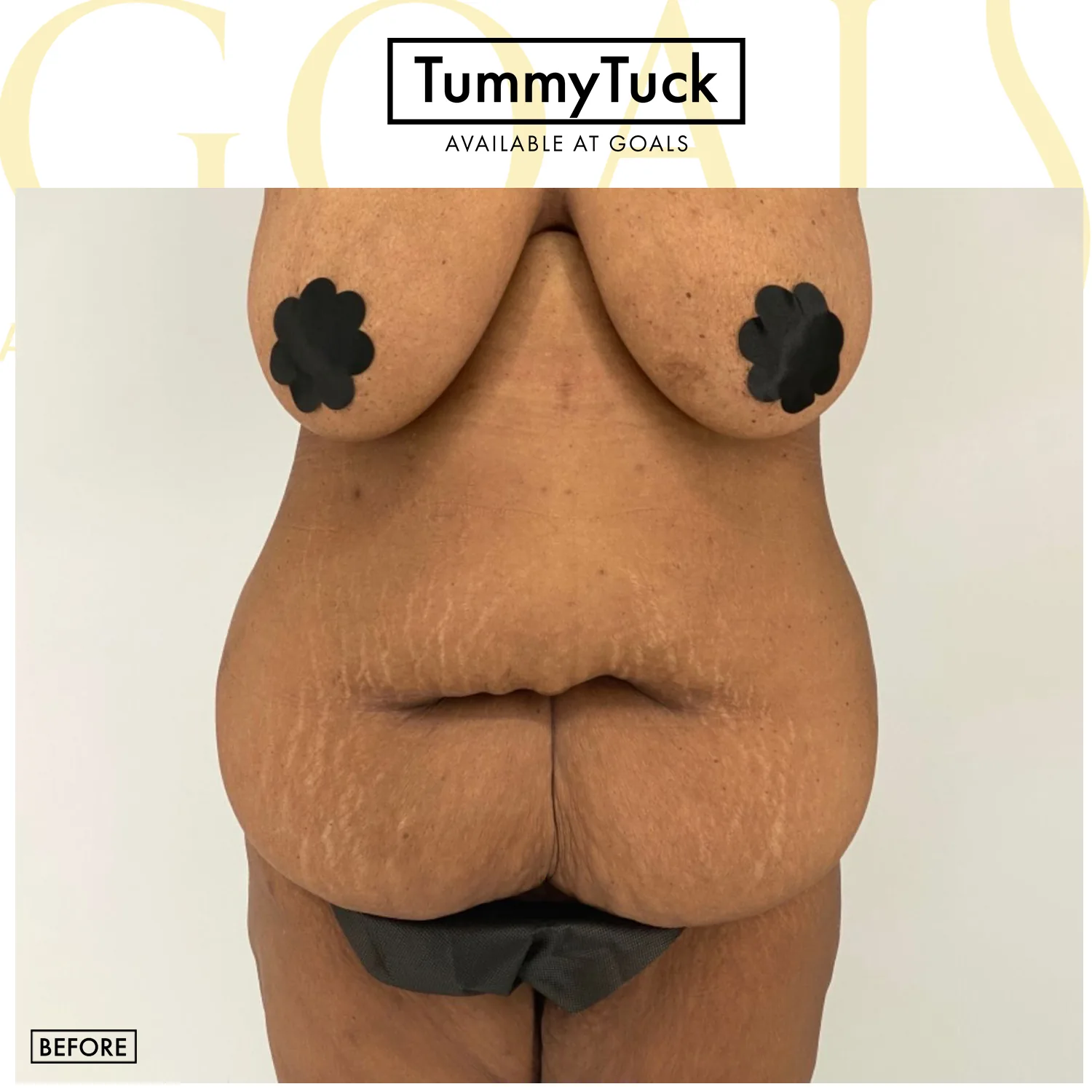 Before and after — Tummy Tuck, patient 3