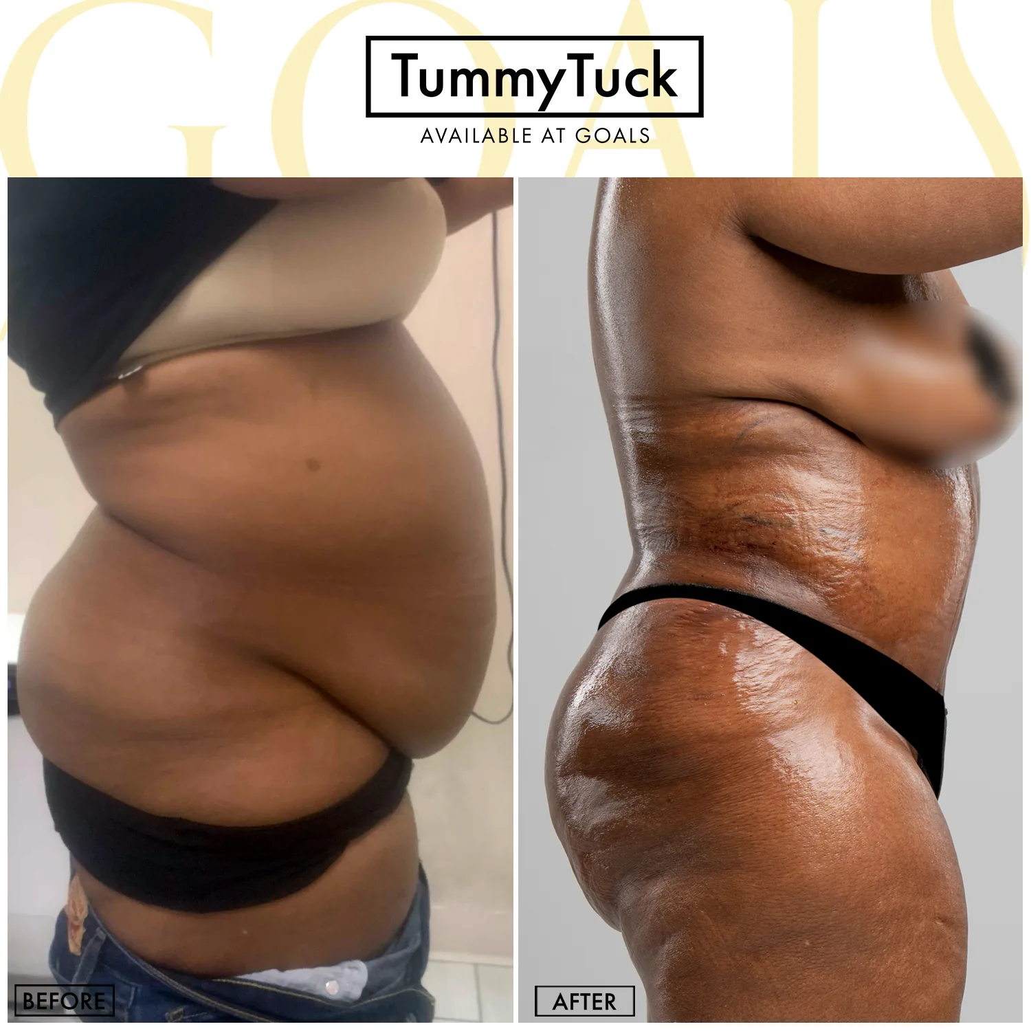 Before and after — Tummy Tuck, patient 4
