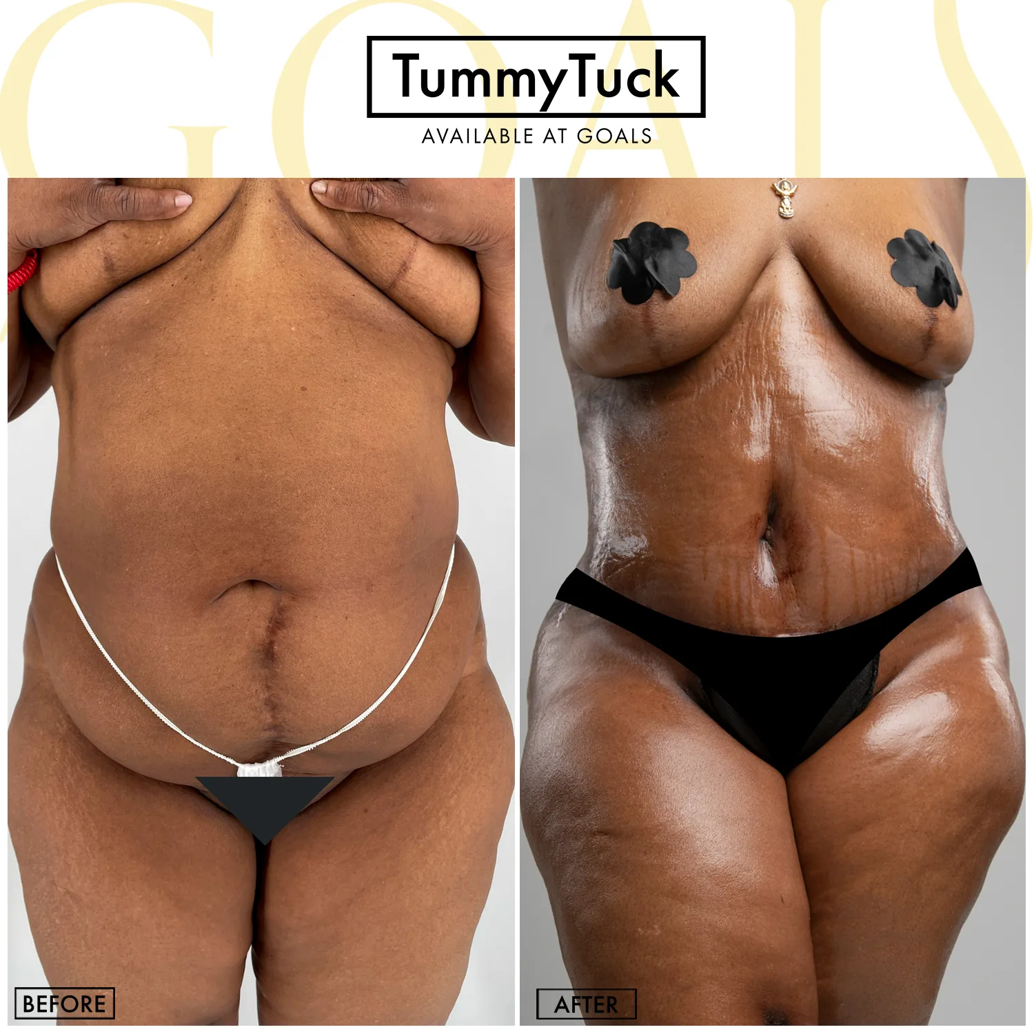 Before and after — Tummy Tuck, patient 6